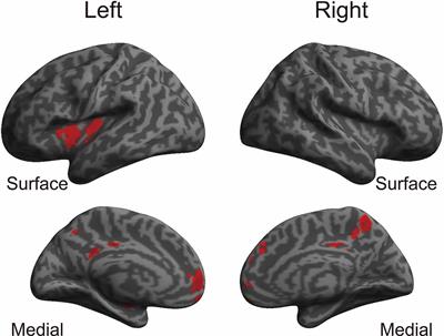 Impact of Early-Commenced and Continued Sports Training on the Precuneus in Older Athletes